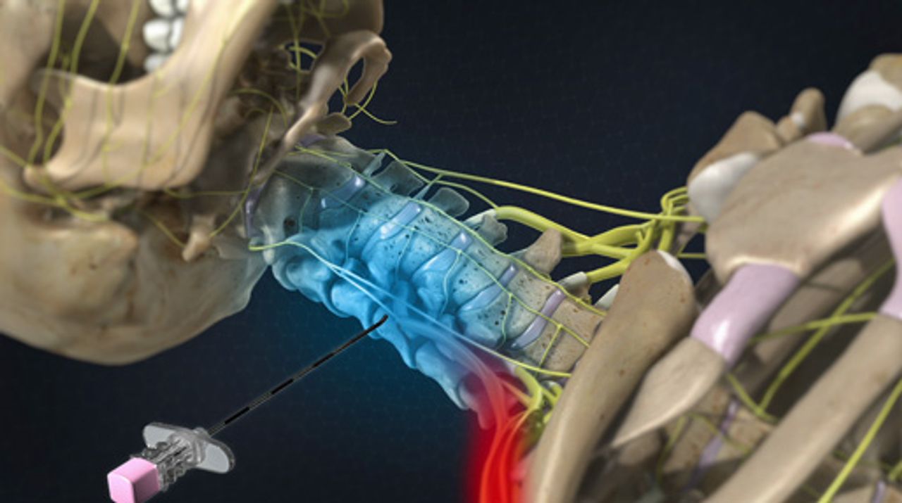 Spinal Cord Stimulator Implant And How It Can Help You - OAS