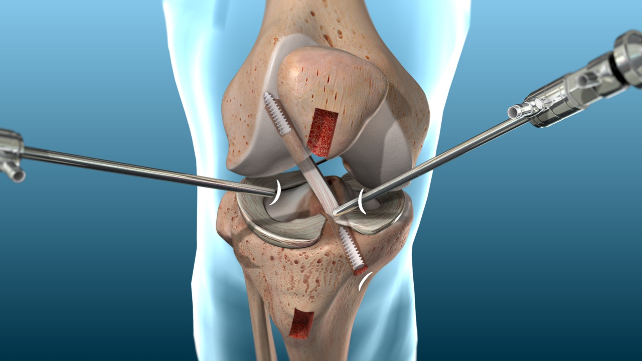 ACL reconstruction