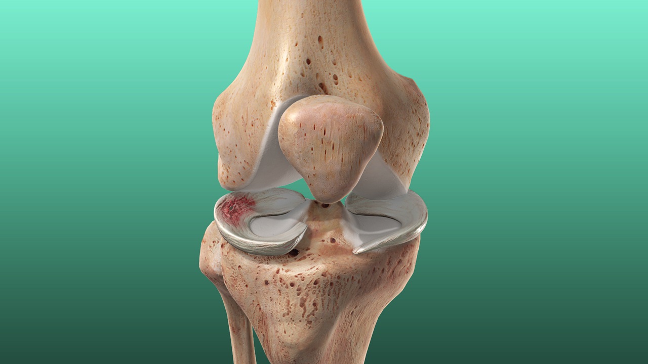 Meniscus Tear - Pontchartrain Orthopedics Sports Medicine