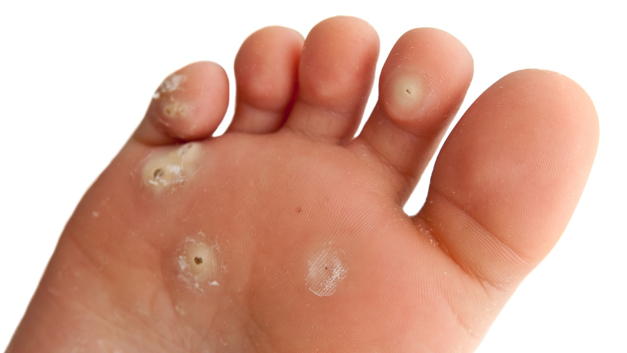 Wart on foot cure. Wart on foot with black center