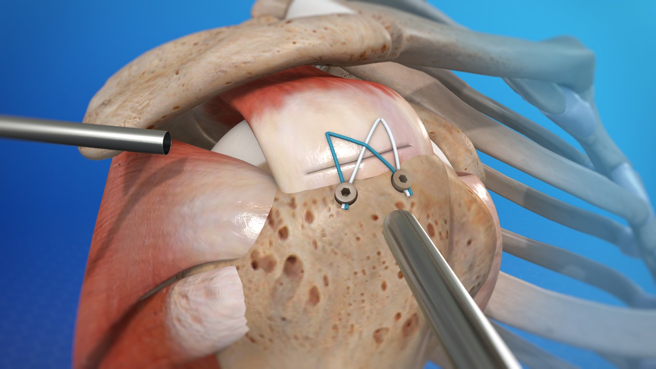 Arthroscopic repair of the rotator cuff in the shoulder | Joint-surgeon.com