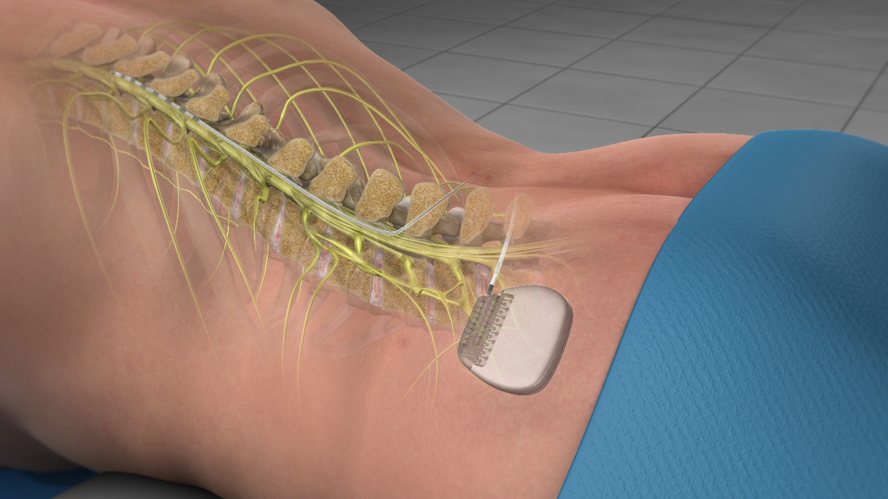 Global Spinal Cord Stimulation Devices Market